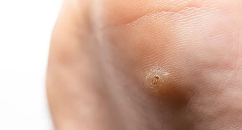 6 Tips on How to Get Rid of Verrucas or Warts. — Credihealth Blog