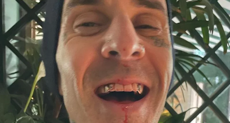 Kardashian fans rip Kourtney's 'gross' husband Travis Barker after drummer shares photo of his mouth dripping with blood