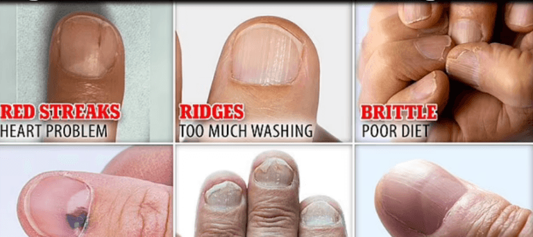 What Does Your Nail Say About Your Health? Warning Signs To Look Out For