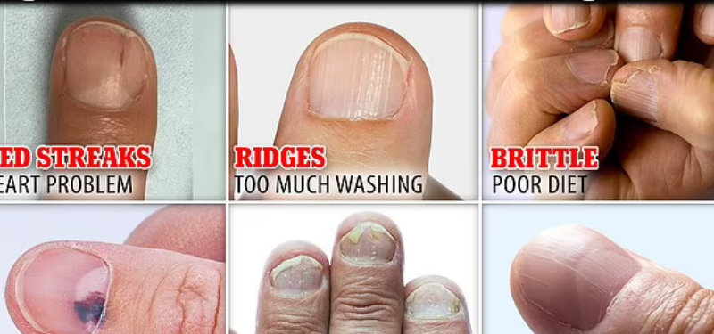 What Does Your Nail Say About Your Health? Warning Signs To Look Out For