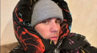 Justin Bieber facial paralysis And Diagnoses: What Is Ramsay Hunt Syndrome Diagnosis?