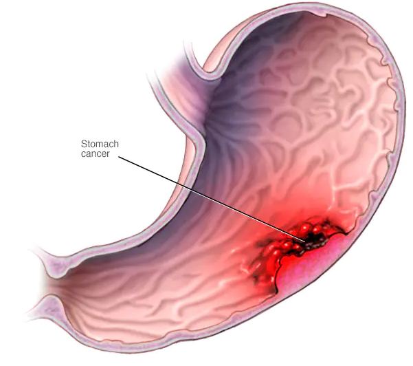 What Is Stomach cancer? Warning Signs, Causes And Prevention Of Stomach Cancer