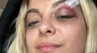Bebe Rexha has reveals her injuries