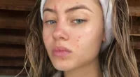 Leni Klum displays candid image of skin break-outs she has suffered for years