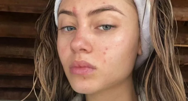 Leni Klum displays candid image of skin break-outs she has suffered for years