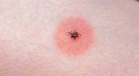 What Is Babesiosis? What To Know About The New Tick-Borne Disease