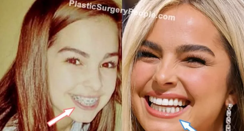 Addison Rae Teeth