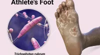 Athlete’s Foot Condition And Treatment | Stock Photo