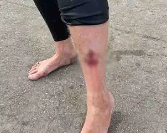 California surfer suffers bite to leg in reported shark attack