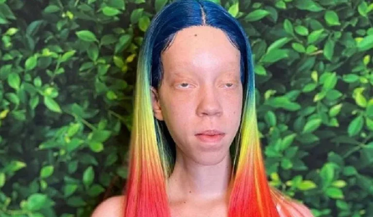 Did Shaydee Albino Passed Away? TikTok Controversy Explained