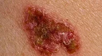 Melanoma now no longer the leading cause of skin cancer deaths
