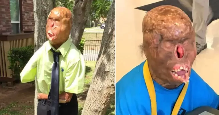 Zaid Garcia Before And After: How Did He Get Burned?