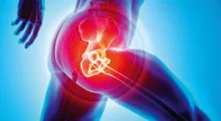 Essential Lifetime Precautions After Hip Replacement Surgery