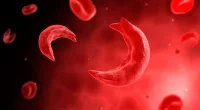 Sickle cell disease patients, of which there are around 15,000 in the UK, do not make haemoglobin properly — a substance in red blood cells, which carry oxygen around the body. As a result, their red blood cells become rigid and shaped like a crescent instead of a disc (pictured), which can cause them to die and become stuck in blood vessels