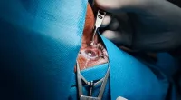 Is Cataract Refractive Surgery Safe? | Stock Photo, Image