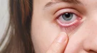 Melanoma Eyelid: Causes, Symptoms, Diagnosis, and Treatments