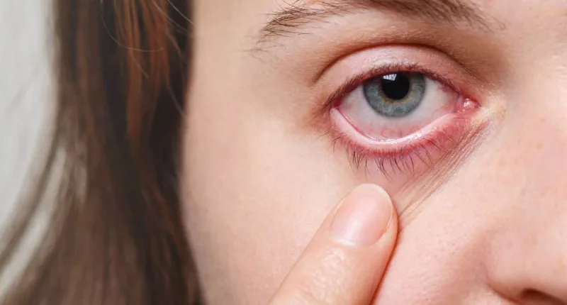 Melanoma Eyelid: Causes, Symptoms, Diagnosis, and Treatments