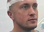 Why Dan Osborne Had A Hair transplant?