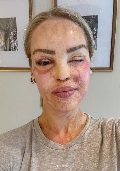 Katie Piper Eye Surgery: What Happened To Katie Piper?