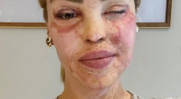 Katie Piper Eye Surgery: What Happened To Katie Piper?