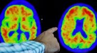 Several Alzheimer's vaccines enter clinical trials amid breakthrough treatments' success