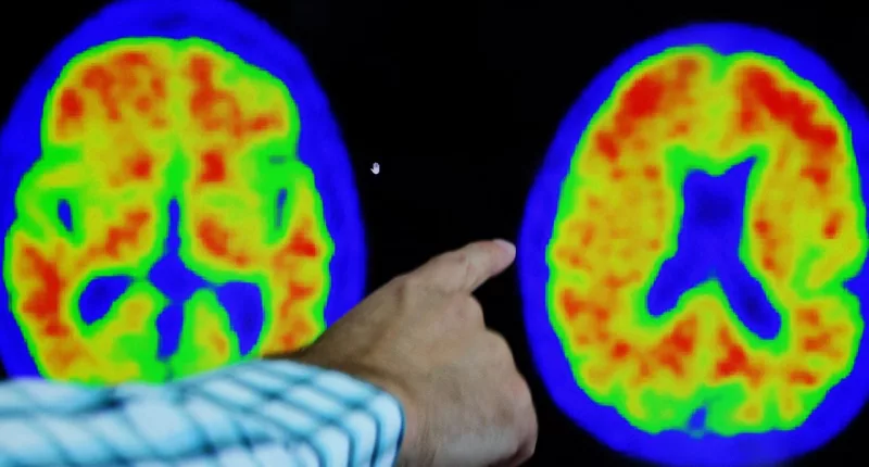 Several Alzheimer's vaccines enter clinical trials amid breakthrough treatments' success