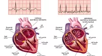 Understanding Atrial Fibrillation: What You Need to Know to Manage Your Condition