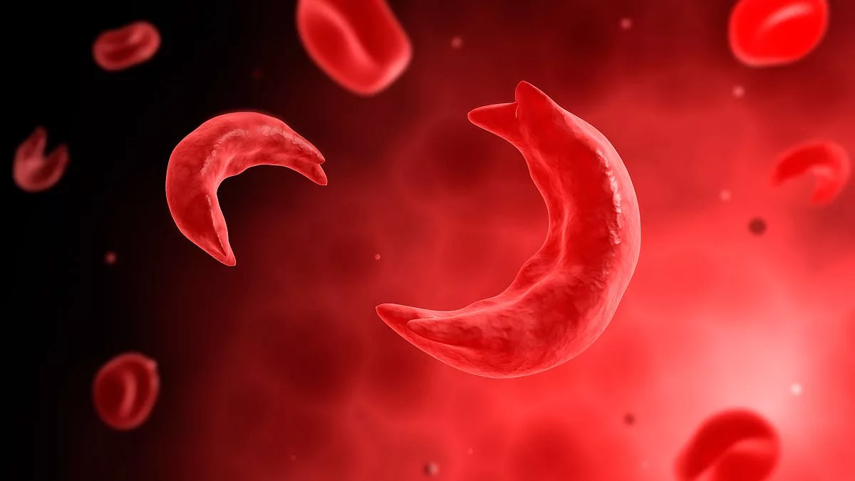 FDA approves gene-editing drug for treatment of sickle-cell disease