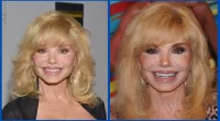Has Loni Anderson Done Plastic Surgery? Before And After Photos