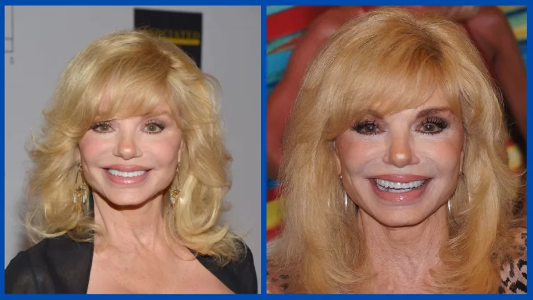Has Loni Anderson Done Plastic Surgery? Before And After Photos