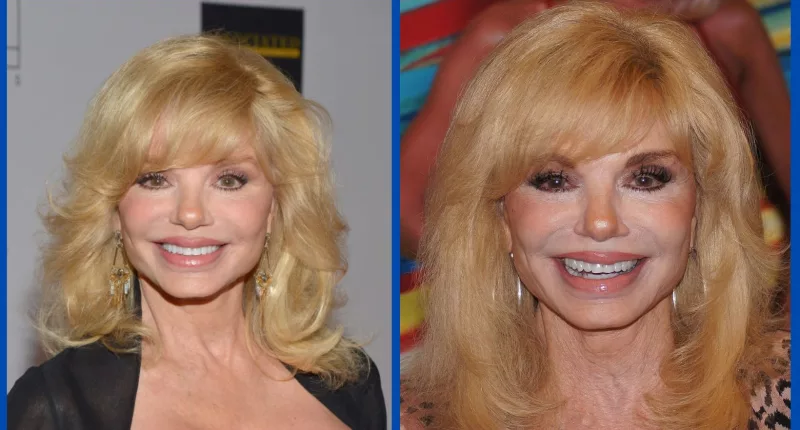 Has Loni Anderson Done Plastic Surgery? Before And After Photos
