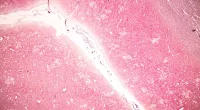 Placental GBS DNA Linked to Higher Neonatal Unit Admissions
