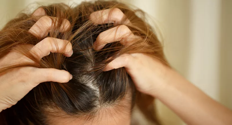 There’s a Link Between Psoriasis and Hair Loss: Here’s What Dermatologists Want You To Know
