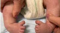 newborn condition causes conjoined toes and 'rocker bottom feet'