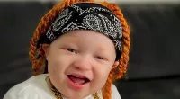 Black mother gives birth to an albino baby with ginger hair