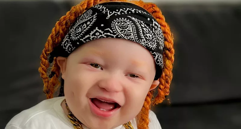Black mother gives birth to an albino baby with ginger hair