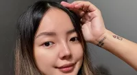 Rosmar Tan Before Surgery