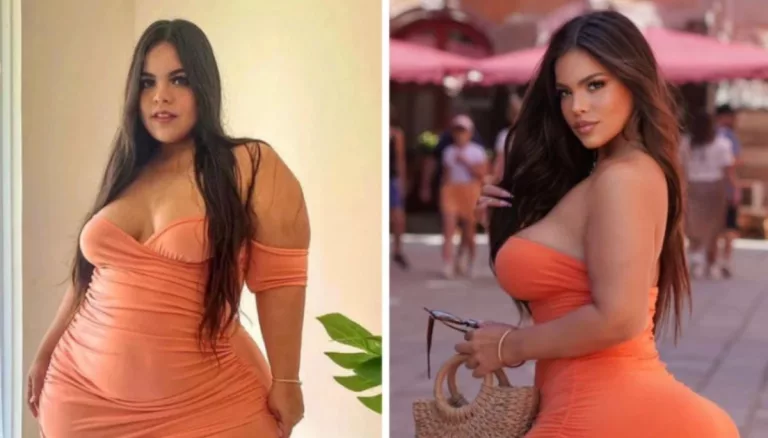 Gracie Bon Before Surgery, Who Was Her Surgeon? New Look