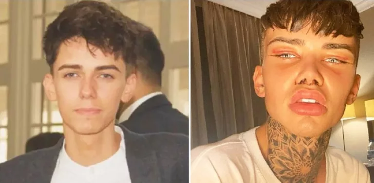 Is Levi Jed Murphy Gay? Surgery Update 2024