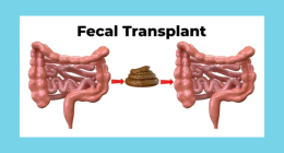 Fecal Transplants for Weight Loss: A Review of the Latest Research
