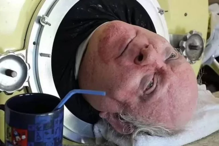 Paul Alexander’s Paralysis from Polio: Addressing Weight Loss Speculation