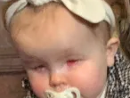 Baby Born Without Eyes: What Is Bilateral Anophthalmia?