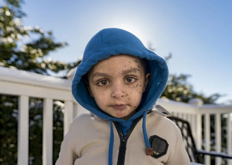Wikipedia and Age of Omar Abu Kuwaik: Story of the Young Boy Who Lost His Arm