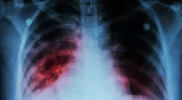 'Small number' of tuberculosis cases at Chicago migrant shelters