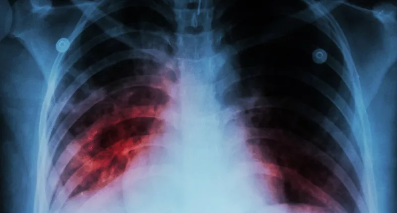 'Small number' of tuberculosis cases at Chicago migrant shelters