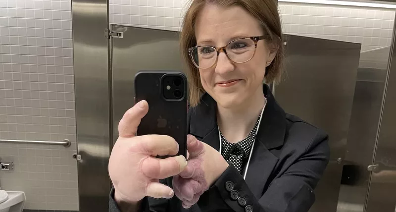 Rare disease affecting just 200 people leaves woman with swollen hands