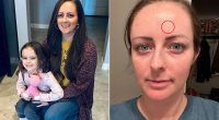 Mum's shock as tiny spot on her forehead turns out to be cancer