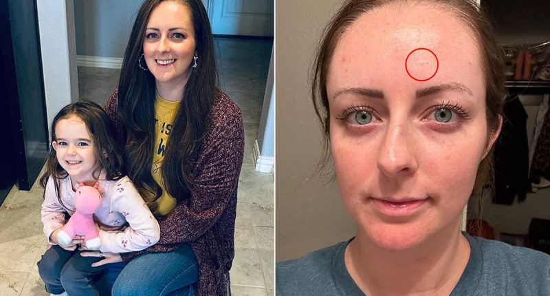 Mum's shock as tiny spot on her forehead turns out to be cancer