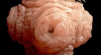What Is Neurocysticercosis? Its Causes, Symptoms And Treatment