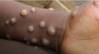 Monkeypox  Outbreak: Mpox Definition, Signs, And Symptoms